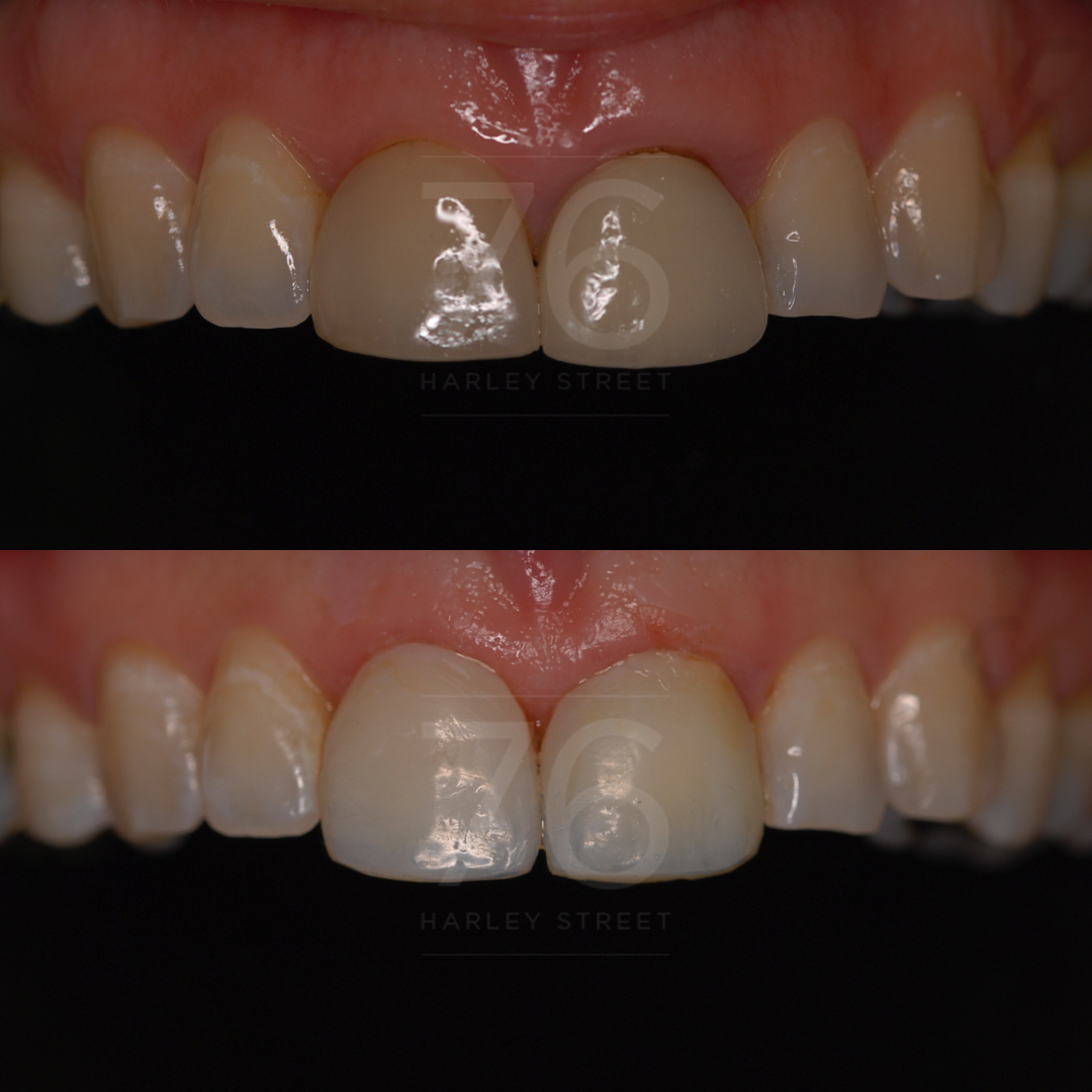 Composite Veneers 76 Harley Street