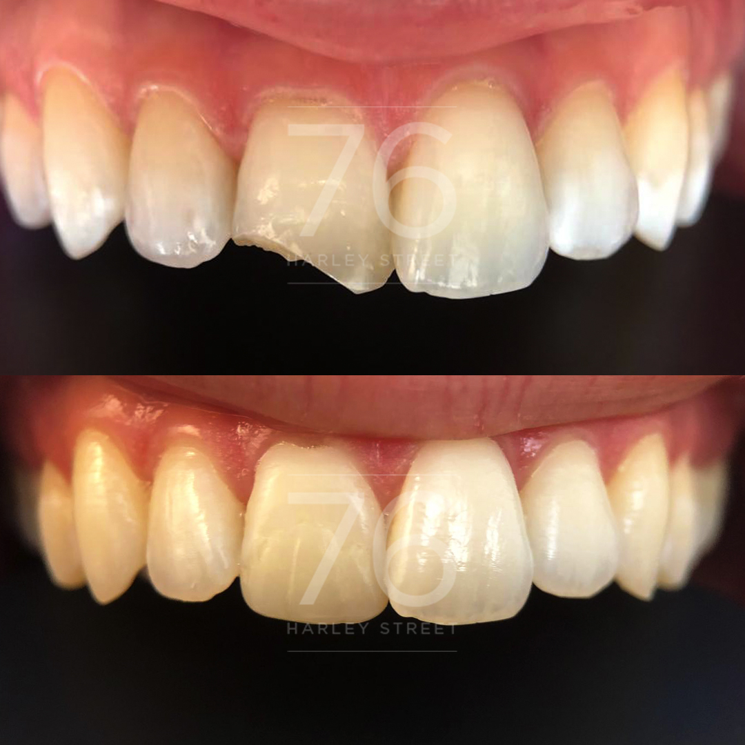 Composite Veneers 76 Harley Street