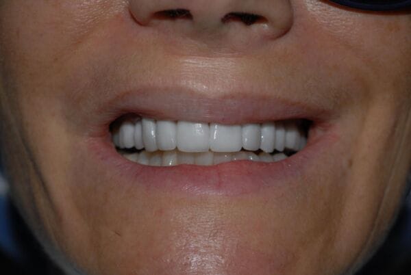 porcelain veneers