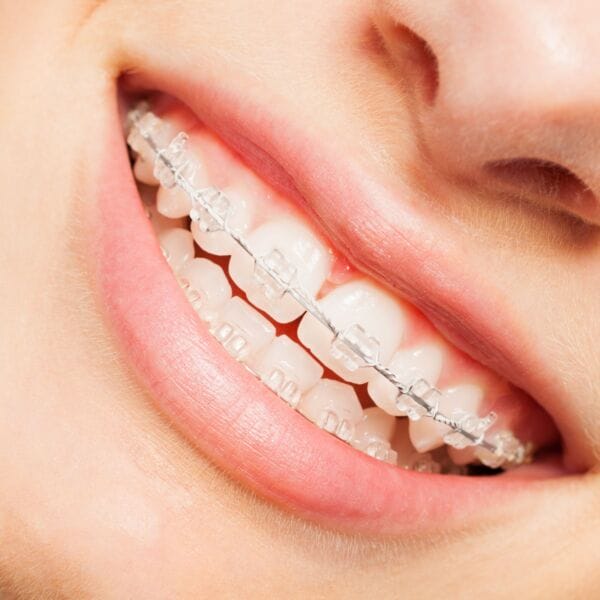 Ceramic Braces Harley Street