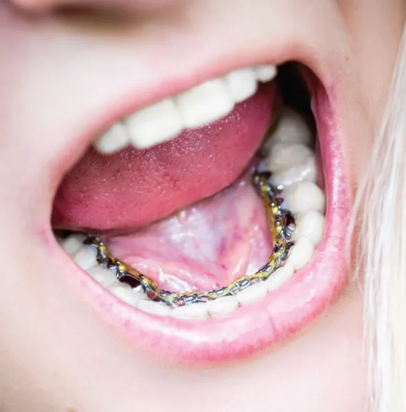 lingual braces harley street