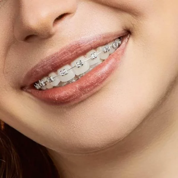 metal braces harley street