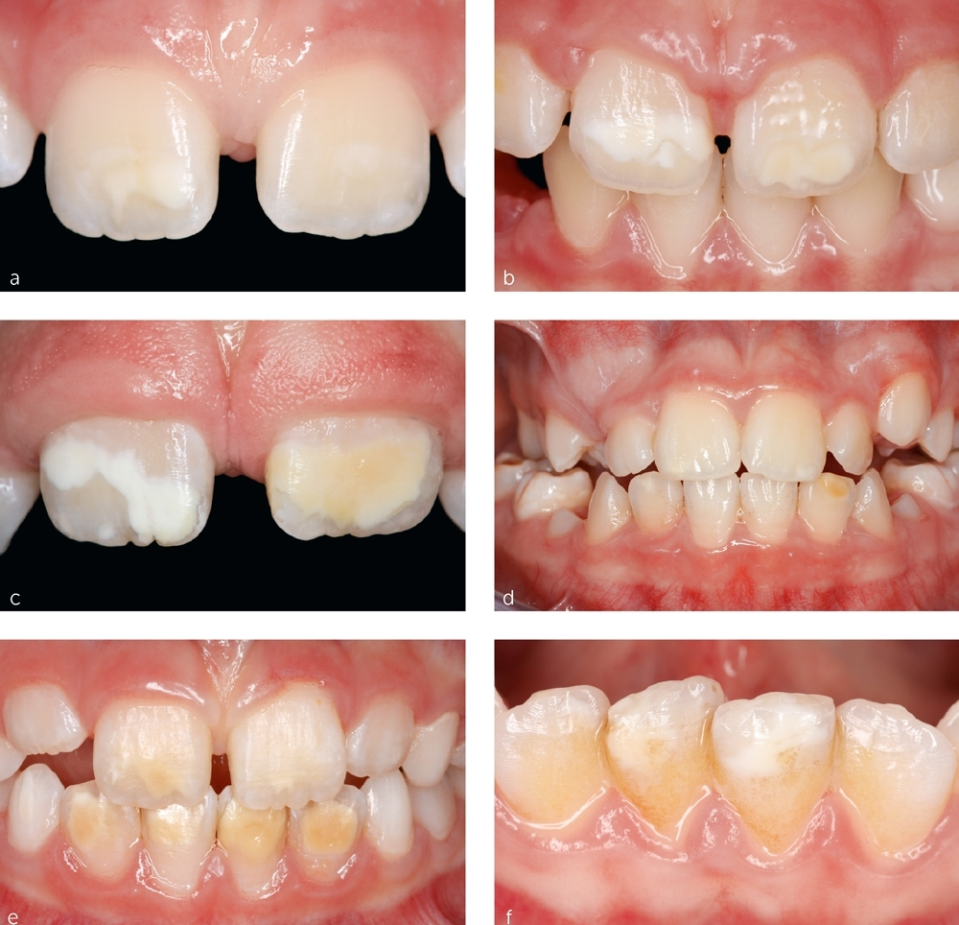 hypomineralisation treatment