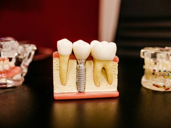 Dental Implant sample