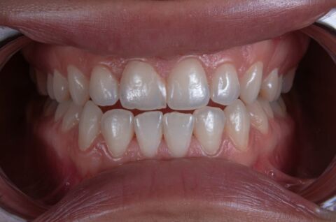 Post-Orthodontic Cosmetic