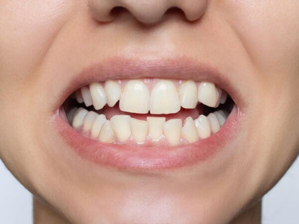 crooked teeth